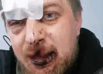 У Дніпропетровській області жорстоко побили волонтера та учасника акції «Гроші на ЗСУ»