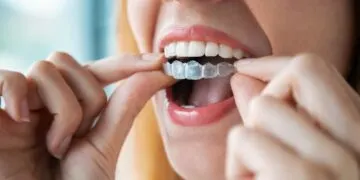 Елайнери Invisalign: повний гайд для споживача